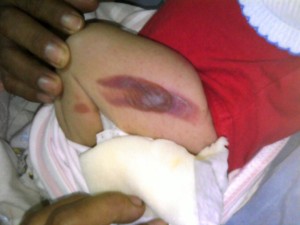 Dolor. Esta es la herida producida en el muslo de la recién nacida, por un instrumento caliente usado durante el parto.