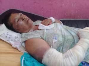 La mujer sufrió quemaduras / Foto 660 AM