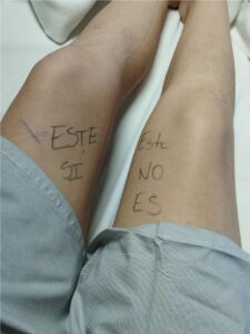 Ingeniera marca su rodilla antes de cirugía para evitar errores médicos